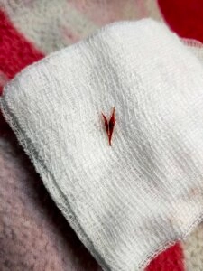 Close-up of several sharp grass seeds placed on a white medical gauze pad against a red fabric background