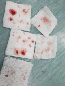 Blood stained gauze pads with several removed grass seeds placed on a medical surface Staffy Grass Seed